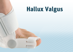 HALLUX VALGUS – Деформирмитет на палецот на стапалото