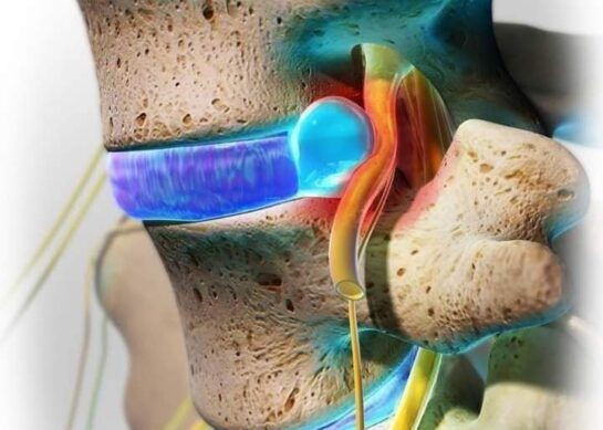 Кинезитерапија и рехабилитација при лумбална дискус хернија