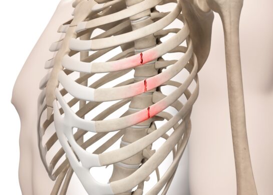Физиотерапија при скршеници и контузии на ребра и граден кош