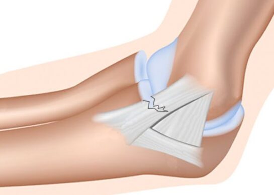Истегнување во зглобот на лактот