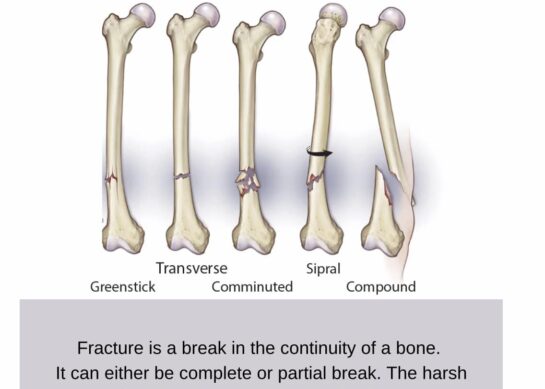 Фрактура-скршеница