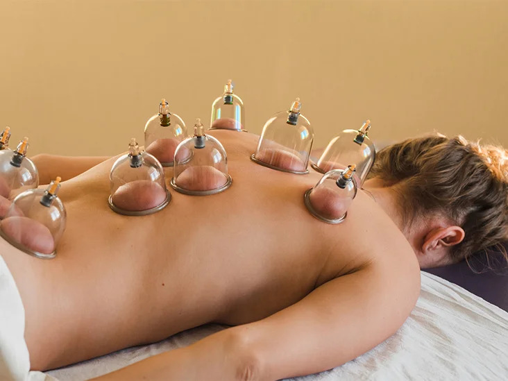 Cupping терапија