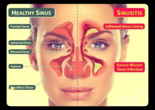 Физиотерапевтски третман на синузит