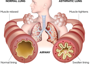 ASTHMA – АСТМА