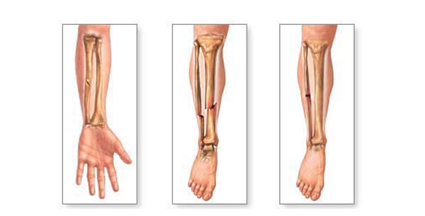 Fractura male sanata