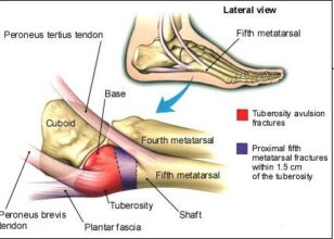 Абрис фрактура на 5-та метатарзална коска – физиотерапевтски третман и рехабилитација